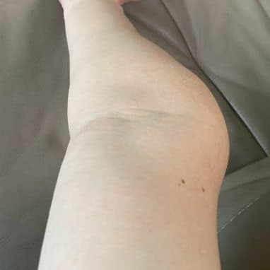 초등학생 팔꿈치 골절 후유증 - 척골신경마비