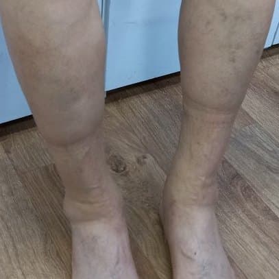 노인 발이 부었을 때 - 노인 발 부종