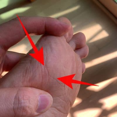 족저근막염 증상 및 치료 후기